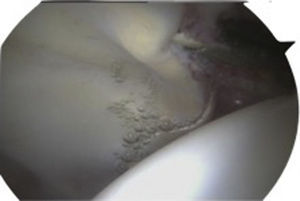 Imagen intraoperatoria de la cadera derecha desde el portal anterolateral con lesión cartilaginosa acetabular de reblandecimiento (softening of cartilage).
