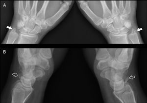 Imágenes radiográficas anteroposterior (A) y lateral (B) de ambas muñecas en el momento de la caída. En la imagen A no se aprecian evidentes signos de fractura de escafoides. Estiloides cubital prominente (flecha). En la imagen B existe un arrancamiento óseo del dorso de ambos piramidales (flecha hueca) que pasó desapercibido en urgencias.