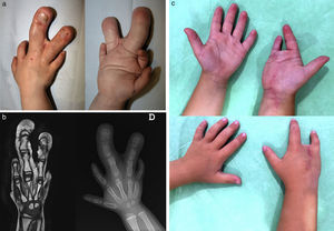 a) Macrodactilia por hamartoma lipofibromatoso. b) Imagen radiológica y resonancia magnética. c) Resultados a los 2 años de evolución.