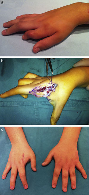 a) Secuelas de sindactilia compleja. b) Imagen intraoperatoria. c) Resultados a los 3 años de evolución.