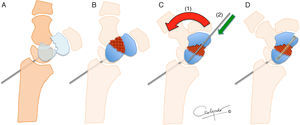Técnica de reconstrucción del escafoides asistida por artroscopia. Tras el fresado de los bordes, se fija el semilunar al radio para reducir el polo proximal (A). Se aporta el injerto en el espacio creado (B) y se reduce la muñeca en máxima extensión (C) para colocar el polo distal en su situación más anatómica (1) y darle longitud. Se fija con una aguja de Kirschner de 1,2mm (2) y se fijan ambos segmentos con el injerto incorporado con un tornillo canulado sin cabeza (D).