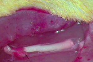 Imagen intraoperatoria de la implantación de la prótesis de nervio acelular con un tubo de ¿-CPL (G2).