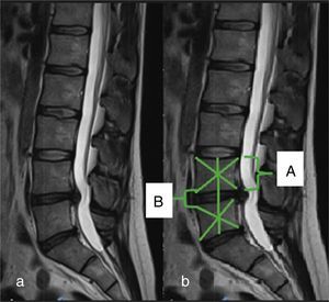 Paciente de sexo masculino de 34 años con hernia discal lumbar central L4-L5. Medición del porcentaje de altura discal a nivel de la hernia con respecto a la vértebra suprayacente: a) corte sagital de resonancia magnética; b) medición de la altura discal sagital y cuerpo vertebral superior. Índice altura discal (B/A×100).