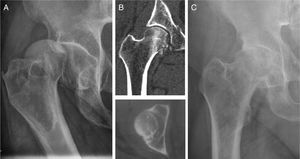 A) Paciente N.o 22. Fractura-luxación posterior de la cadera derecha asociada a fractura de la cabeza femoral (Thompson-Epstein tipoV). B) TAC tras la reducción cerrada mostrando fragmentos intraarticulares en la zona posteromedial e inferior de la cadera. La mayoría de los fragmentos eran inferiores a la fóvea. El fragmento central no fue retirado debido a comorbilidades médicas asociadas del paciente. C) Radiografía simple mostrando signos artrósicos de la cadera, 12 años tras la lesión inicial.