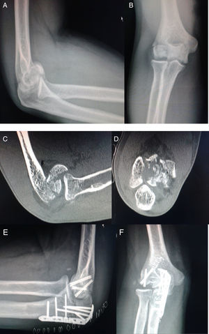 De izquierda a derecha y de arriba abajo: A y B) Imágenes radiográficas lateral y AP de la fractura. C y D) Imágenes TC de la fractura. E y F) Imágenes radiográficas lateral y AP de la osteosíntesis 6días después.