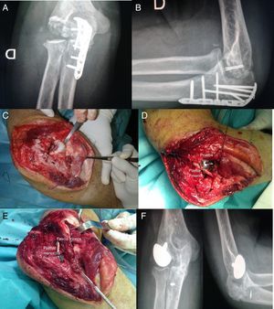 De izquierda a derecha y de arriba abajo: A y B) Imágenes radiográficas que muestran la artrosis del capitellum (11meses después de la osteosíntesis). C) Imagen intraoperatoria que muestra el aspecto del capitellum con importantes cambios degenerativos, 16 meses tras la osteosíntesis. D) Imagen con el componente de prueba de la prótesis de la hemiartroplastia. E) Prótesis implantada y estabilización con ligamentoplastia. F) Imagen radiográfica AP y lateral al año de realizar la hemiartroplastia de resuperficialización.