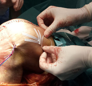 Fijación del catéter con sutura cutánea adhesiva.