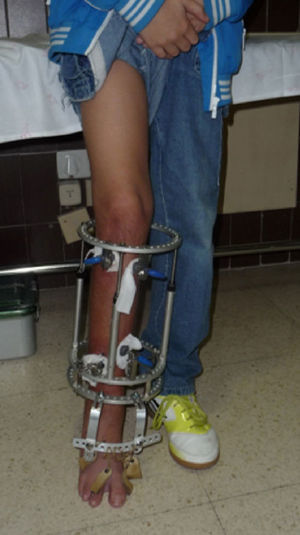 Paciente portando un fijador circular en un caso sin apoyo de clavo intramedular.