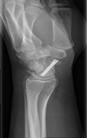 Proyección lateral de una osteosíntesis percutánea de fractura de escafoides.