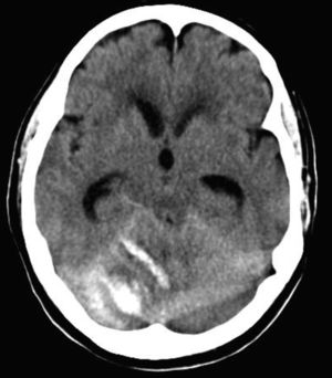 Corte de la TC cerebral tras intervención quirúrgica. Hemorragia cerebelosa con el «signo de la cebra» localizado en el hemisferio cerebeloso derecho, con HSA y HS asociados.