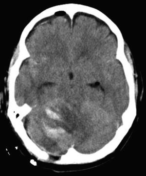 Corte de la TC cerebral tras hemicraniectomía occipital. Sin efecto masa y recuperación IV ventrículo. Restos hemorrágicos.