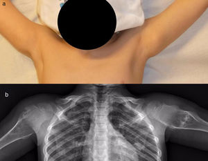 Osteocondromatosis múltiple hereditaria en niño de 4 años de edad tratado de forma conservadora: aspecto clínico (a) y radiográfico (b).