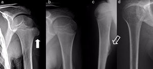 Osteocondromas del extremo proximal del húmero, en un niño de 7 años de edad (flecha llena [a]) y en una niña de 11 años (flecha hueca [c]), con involución espontánea 1 y 2 años más tarde, respectivamente. Controles radiográficos 2 y 6 años después (b y d).