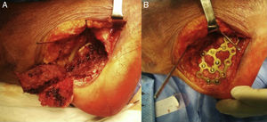 A) Reducción de la articulación subastragalina tras exéresis de la pared lateral. B) Fijación de la fractura mediante placa de reconstrucción de bajo perfil.