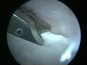 Imagen intraoperatoria de la cadera izquierda desde el portal anterolateral. Desbridamiento con pinza de la lesión cartilaginosa con instrumental introducido por el portal medioanterior.