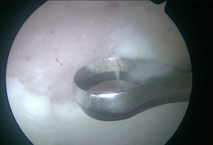 Imagen intraoperatoria de la cadera derecha desde el portal anterolateral. Resección de la capa de tejido calcificado con cureta introducida por el portal medioanterior.