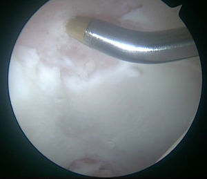Imagen intraoperatoria de la cadera derecha desde el portal anterolateral. Realización de microfracturas con instrumental introducido por el portal medioanterior.