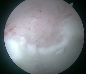 Imagen intraoperatoria de la cadera derecha desde el portal anterolateral. Sangrado por las microfracturas tras cortar el flujo de líquido intraarticular.