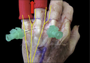 Tracción para la artroscopia del cuarto y quinto dedo. De esta forma el tronco común cubital que inerva DU4 y DR5 queda centrado en el eje de tracción, pudiendo alejar los nervios de la línea media, y por lo tanto de los portales metacarpofalangicos.
