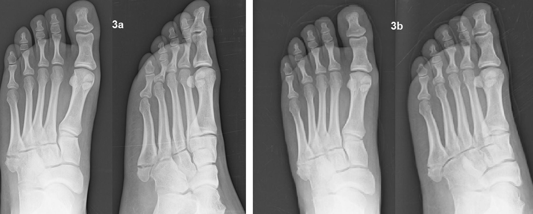 fractura de huesos metatarsianos