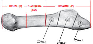 División del quinto metatarsiano en sus zonas anatómicas.