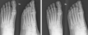 a) Fractura de la base del quinto metatarsiano del pie izquierdo. b) Evolución a los dos meses de tratamiento funcional.