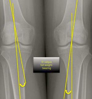 Radiografía AP bilateral en carga. El ángulo anatómico es medido siguiendo el eje femoral y tibial.