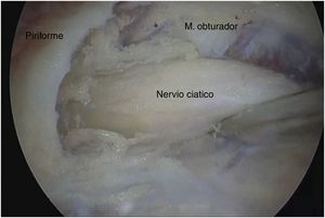 Imagen real de la visualización del nervio ciático, músculo piriforme y obturador externo.