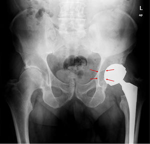 Osteolisis periacetabular en zona 3 de DeLee en paciente portador de prótesis metal-metal con cabeza de gran diámetro.