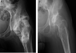 A) Radiografía de caderas en proyección AP en la que se aprecia OPA de cadera izquierda que engloba toda la articulación en un paciente afecto de lesión medular ASIA A de 10 años de evolución. B) Radiografía de caderas en proyección AP a los 3 años tras la exéresis de OPA.