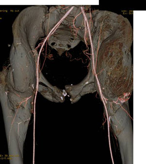 Angio-TC de planificación preoperatoria en la que se puede valorar la vascularización cercana a la OPA de cadera izquierda con el objetivo de minimizar riesgos de daño vascular durante la cirugía.
