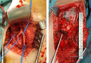A) Arteria femoral superficial y profunda en íntimo contacto con OPA, localizadas antes de la exéresis de OPA de cadera izquierda. B) Imágenes macroscópicas de OPA de cadera izquierda tras abordaje anterior de Smith-Petersen.