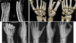 Paciente A: a) radiografías iniciales donde se aprecia la fractura y el aumento del espacio escafolunar; b) tomografía computarizada donde se visualiza la coalición escafotrapezoidea; c) radiografías comparativas de la muñeca derecha; d) radiografías finales del paciente.