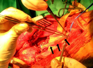 Bypass con prótesis vascular después de la resección de LMS de vena femoral superficial (flechas).