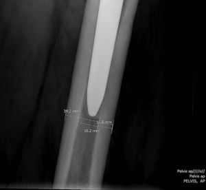 Mediciones radiológicas realizadas al nivel del extremo distal del implante proximal. Diámetro del canal femoral=39,2mm, diámetro del canal medular=16,2mm, diámetro cortical=11,5mm.