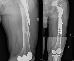 Caso clínico. A) Fractura interimplante de fémur en varón de 74 años portador de una prótesis total de cadera y una prótesis total de rodilla. Platzer tipo IIB1. B) Resultado final del tratamiento de la fractura anteriormente mencionada mediante osteosíntesis con doble placa, con el fin de aumentar la estabilidad del montaje dada la conminución a nivel del foco de fractura.