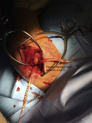 Imagen intraoperatoria con anclaje del injerto en la glena a las 12.