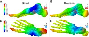 Máxima deformación obtenida al simular el modelo solo manteniendo estructura ósea y cartílagos. La arquitectura y geometría del pie se colapsa en carga en ausencia de estructuras ligamentosas. La osteotomía medializante limita este efecto y hace la bóveda más estable. A y B: valores ángulo Costa Bartani; C y D: valores del ángulo de Kite.