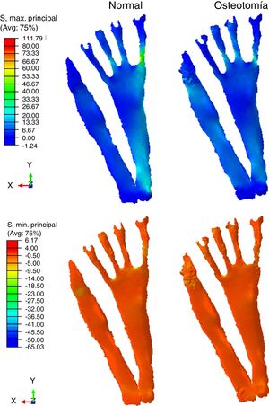 Comparación de la tensión (S) principal máxima percibida sobre la fascia plantar.