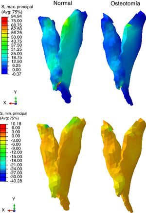 Comparación de la tensión (S) mínima principal percibida el complejo del ligamento Spring.