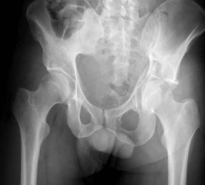 Signo de la gaviota en acetábulo izquierdo (afectación de la columna posterior con impactación marginal).