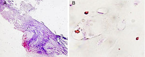 Imágenes de RAM-11 positiva sobre cápsula fibrosa a 160 aumentos (A) y en el territorio óseo a 640 aumentos (B).