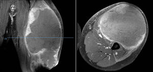 Sarcoma de Ewing extraesquelético en muslo, imágenes de RM en el momento del diagnóstico.
