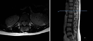 Sarcoma de Ewing extraesquelético epidural a nivel de T11. En los cortes sagitales y axiales se aprecia la importante compresión medular que permitió el diagnóstico precoz.