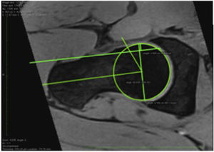 RM con reconstrucción axial oblicua que muestra CFA tipo cam, dado por un ángulo alfa de 66,6° en un participante asintomático.