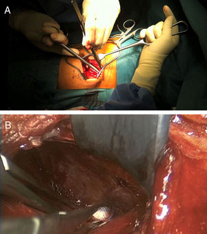 A,B) Disección cuidadosa para separación de pleura parietal y visceral para abordaje retropleural.