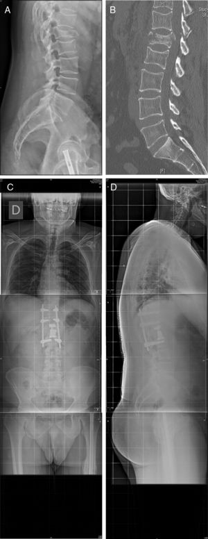 Caso 25: fractura en estallido L1 en paciente politraumatizado en accidente de tráfico (A). La TC (B) muestra afectación del muro posterior y conminución, por lo que se decide tratamiento quirúrgico por doble abordaje: corpectomía por vía retropleural y colocación de un sustituto vertebral, y fijación posterior mediante tornillos percutáneos (C,D). No se produjo apertura pleural durante el abordaje, y el postoperatorio y el seguimiento cursaron sin complicaciones.