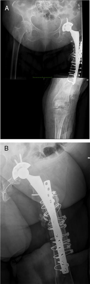 Imagen radiográfica en proyecciones anteroposterior (A) y lateral (B) de uno de los pacientes intervenidos mediante esta técnica quirúrgica.