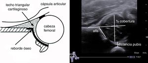 Parámetros ecográficos de estudio: ángulo alfa, porcentaje de cobertura de la cabeza femoral y distancia a pubis.