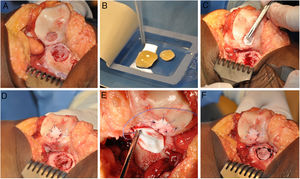 Procedimiento quirúrgico HD-ACI (condrocitos autólogos de alta densidad) en un paciente que presenta 2 lesiones en la rodilla: rótula y cóndilo femoral externo (tróclea). Una vez que las lesiones de cartílago han sido desbridadas (A), los condrocitos cultivados se siembran en las membranas previamente recortadas según el tamaño y forma de las lesiones y se espera 10min a que las células sean absorbidas (B). Se coloca una de las membranas en la primera lesión y se sutura a cartílago adyacente (C y D). A continuación se procede a la colocación y sutura de la otra membrana en la segunda lesión (E y F).
